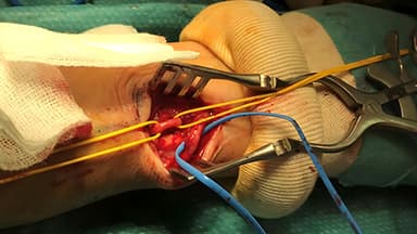 Creación de fístulas arteriovenosas (FAV)