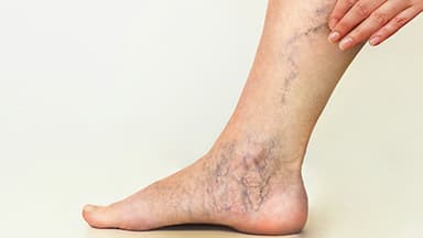 Arañas vasculares (Telangiectasias)