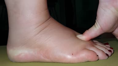 Hinchazón en piernas o pies (Edema)