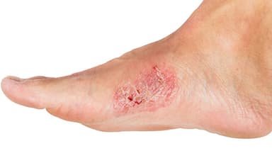 Úlceras o heridas que no cicatrizan